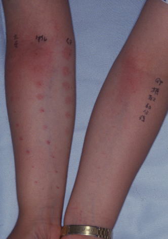 鯖 アレルギー 蕁麻疹 写真