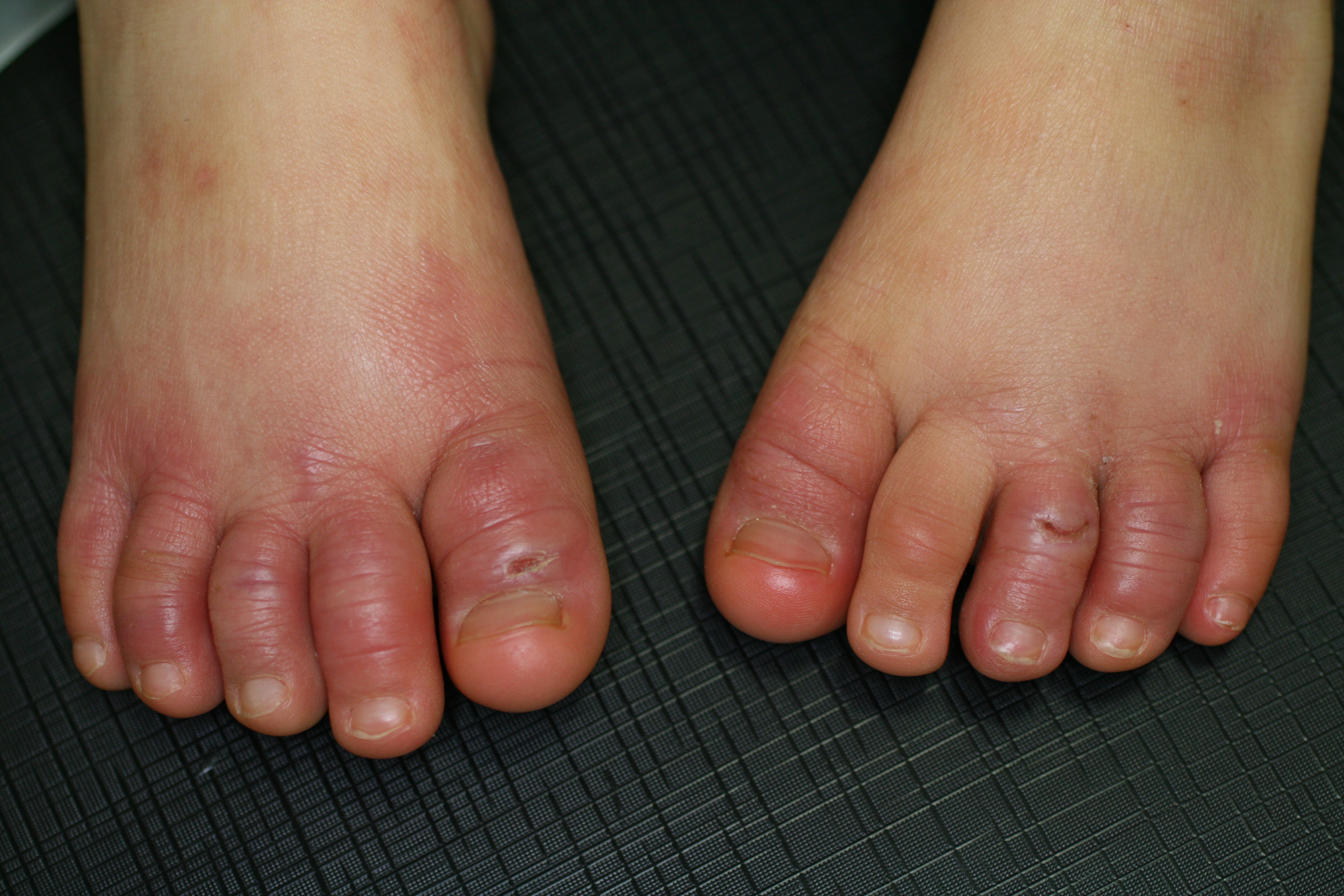足 の 指 ぶつけ た 腫れ